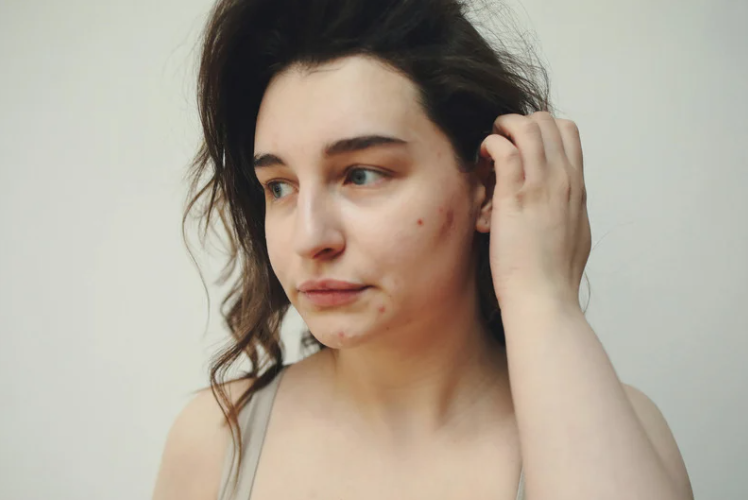 How to Beat Acne